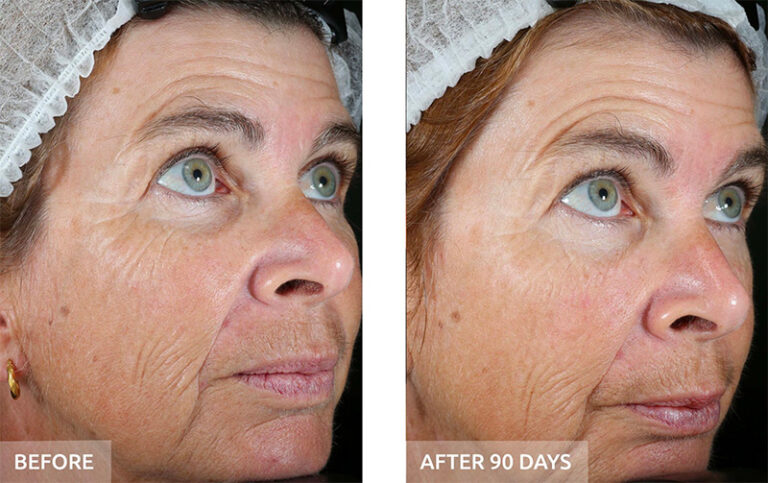 Side-by-side close-up photos of a woman's face labeled "Before" and "After 90 Days," showing reduced wrinkles and smoother skin in the "After" image. - Garbo A Salon & Spa TX