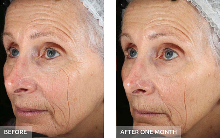 Fine Lines Before and After