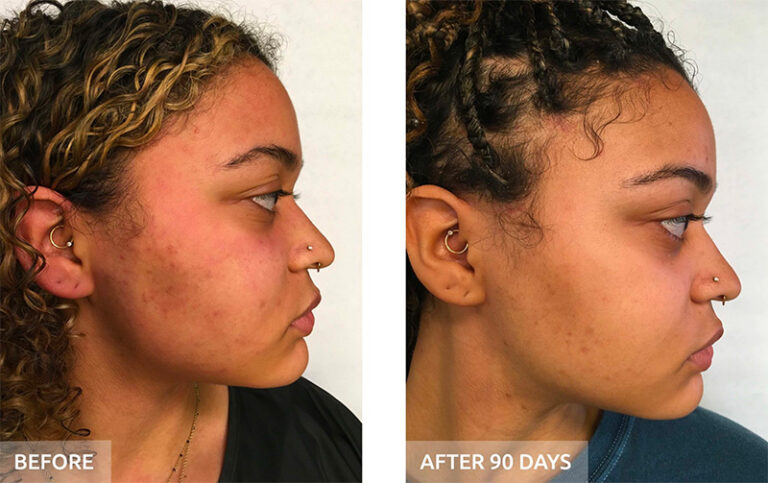 Side profile comparison of a woman's face before and after 90 days, showing reduced redness and acne. - Garbo A Salon & Spa TX