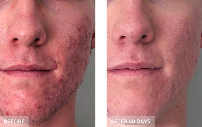 Side-by-side close-up of a person's lower face showing acne before treatment and clearer skin after 60 days. - Garbo A Salon & Spa TX
